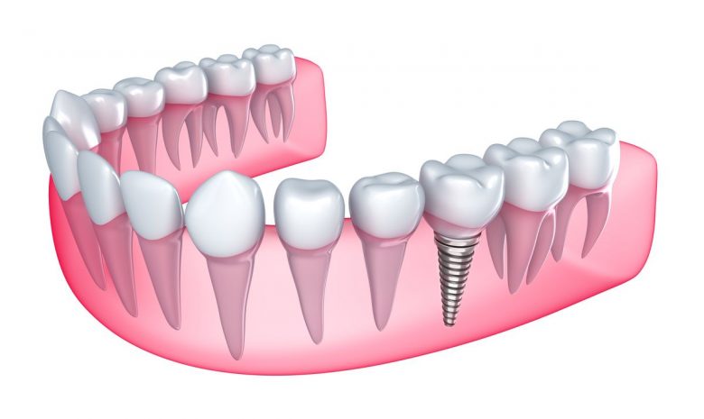 Root Canal Treatments Chippewa Falls