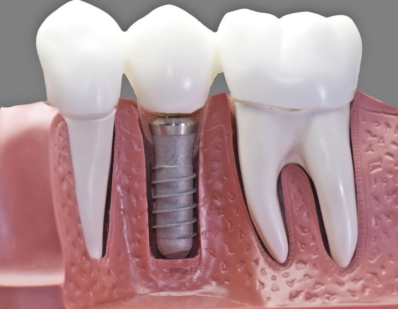 Best Dental Implant Center