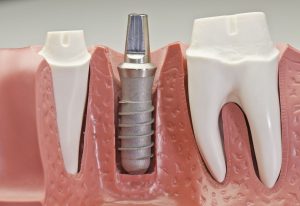 Dental Implants Chippewa Falls