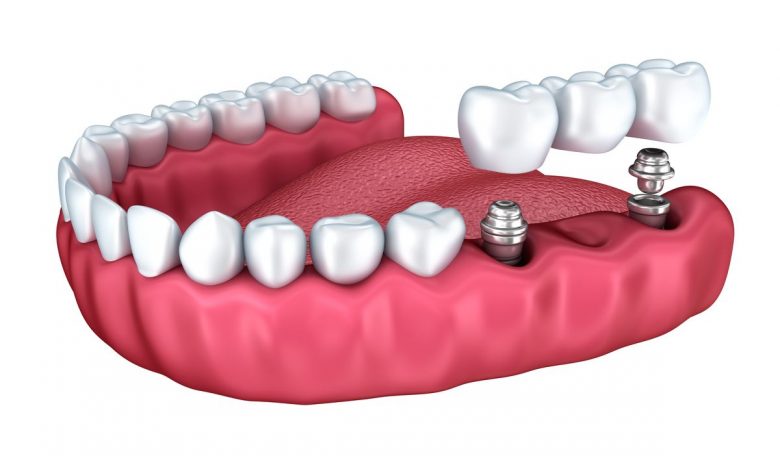 Dental Implants Chippewa Falls