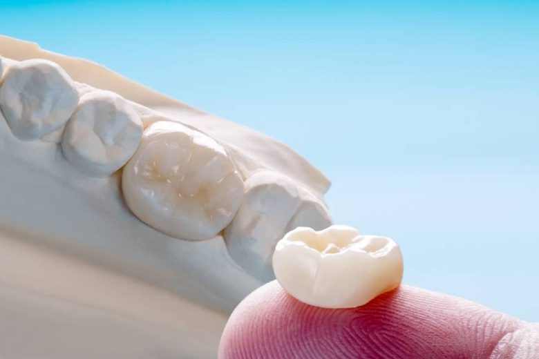 dental crowns chippewa falls