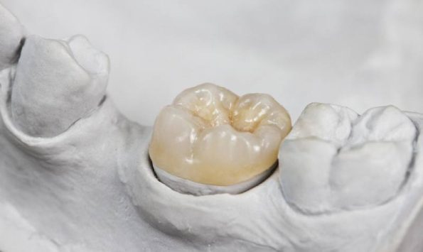 dental inlay